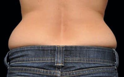CoolSculpting® Before & After Gallery - Patient 9605696 - Image 1