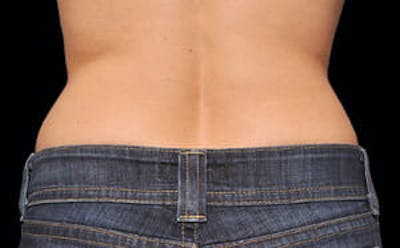 CoolSculpting® Elite Before & After Gallery - Patient 9605696 - Image 2