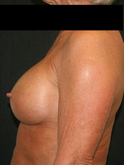 Breast Augmentation Before & After Gallery - Patient 9605695 - Image 6