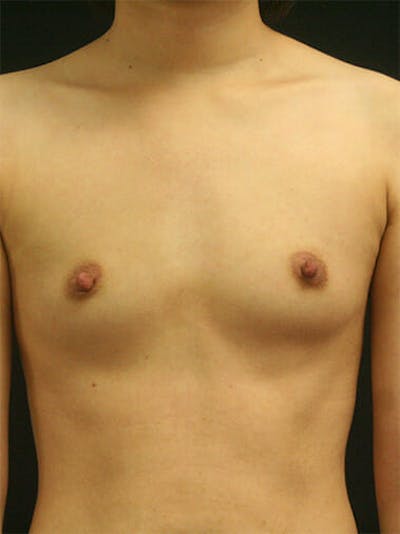 Breast Augmentation Before & After Gallery - Patient 9605698 - Image 1