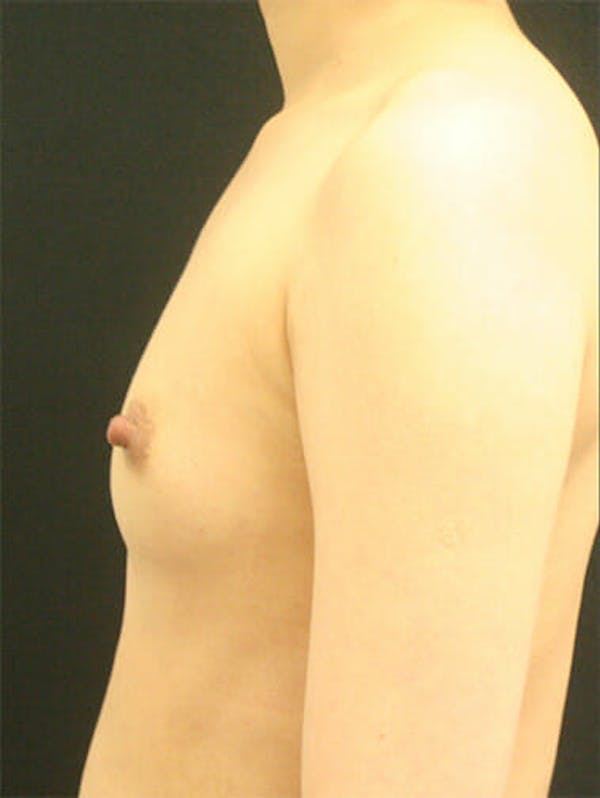 Breast Augmentation Before & After Gallery - Patient 9605698 - Image 5