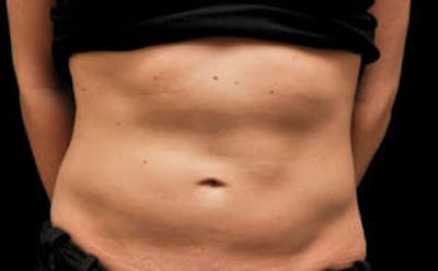 CoolSculpting® Elite Before & After Gallery - Patient 9605699 - Image 1