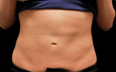 CoolSculpting® Elite Before & After Gallery - Patient 9605699 - Image 2