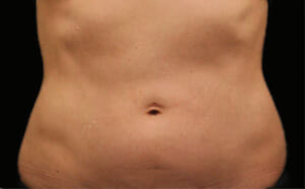 CoolSculpting® Gallery - Patient 9605700 - Image 1