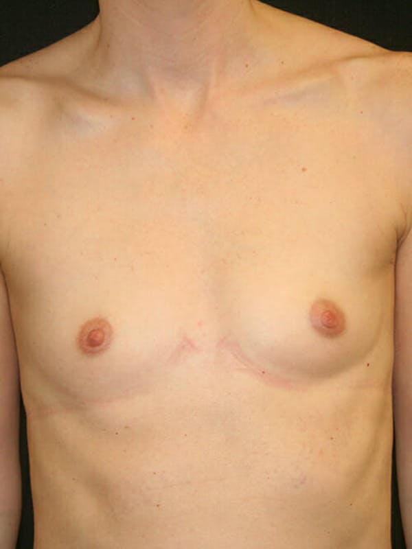 Breast Augmentation Before & After Gallery - Patient 9605704 - Image 1