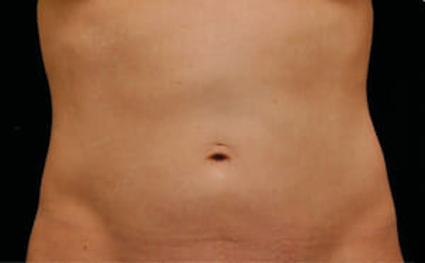 CoolSculpting® Elite Before & After Gallery - Patient 9605700 - Image 2