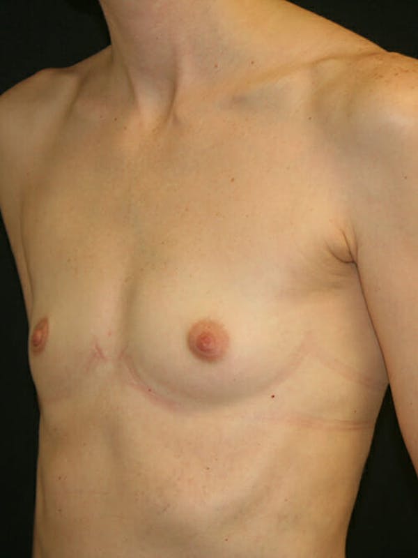 Breast Augmentation Before & After Gallery - Patient 9605704 - Image 3
