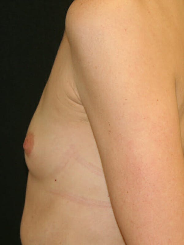 Breast Augmentation Before & After Gallery - Patient 9605704 - Image 5