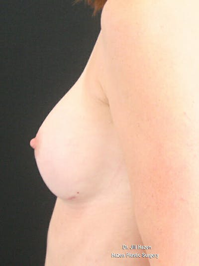 Breast Augmentation Before & After Gallery - Patient 9605704 - Image 6