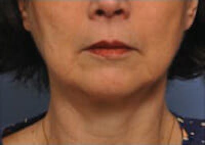 CoolSculpting® Elite Before & After Gallery - Patient 9605705 - Image 1