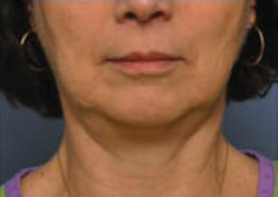 CoolSculpting® Elite Before & After Gallery - Patient 9605705 - Image 2