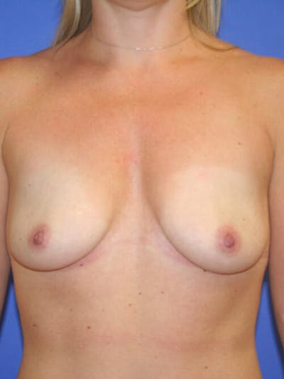 Breast Augmentation Before & After Gallery - Patient 9605715 - Image 1