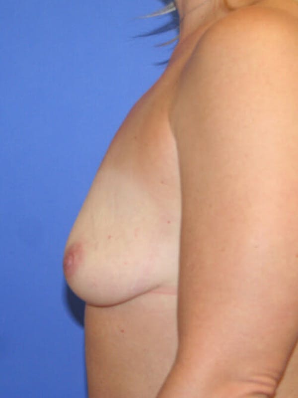 Breast Augmentation Before & After Gallery - Patient 9605715 - Image 5