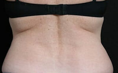 CoolSculpting® Elite Before & After Gallery - Patient 9605716 - Image 2