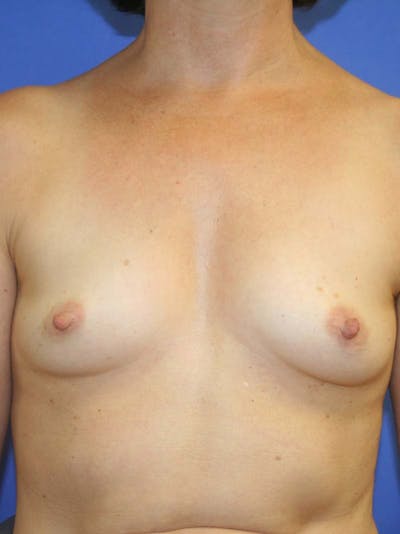 Breast Augmentation Before & After Gallery - Patient 9605732 - Image 1