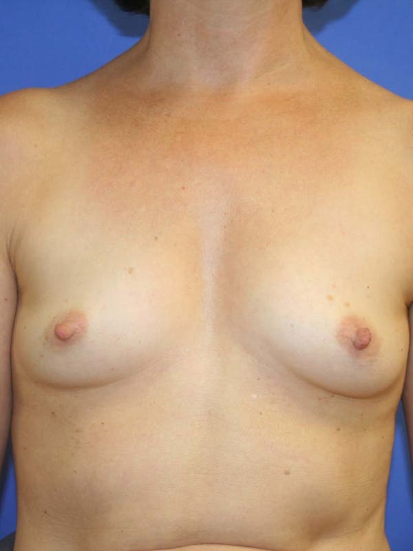Breast Augmentation Before & After Gallery - Patient 9605732 - Image 1