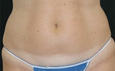 CoolSculpting® Before & After Gallery - Patient 9605731 - Image 1