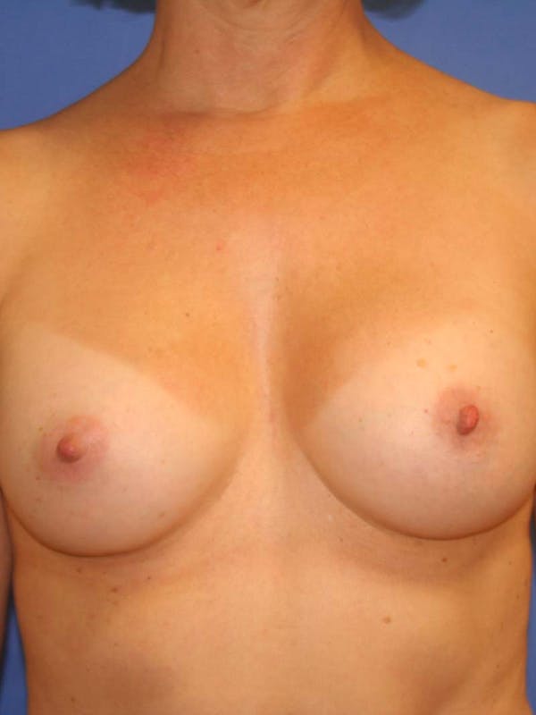 Breast Augmentation Before & After Gallery - Patient 9605732 - Image 2