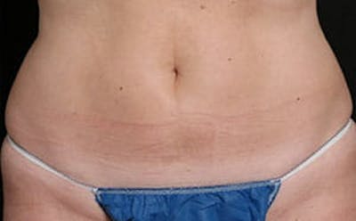 CoolSculpting® Elite Before & After Gallery - Patient 9605731 - Image 2
