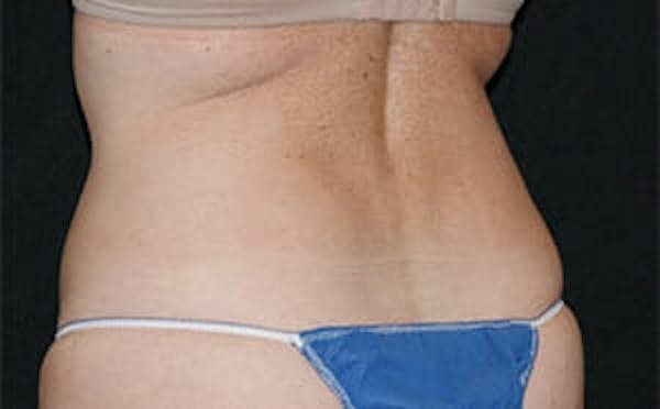CoolSculpting® Elite Before & After Gallery - Patient 9605731 - Image 3