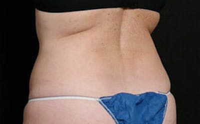 CoolSculpting® Elite Before & After Gallery - Patient 9605731 - Image 4