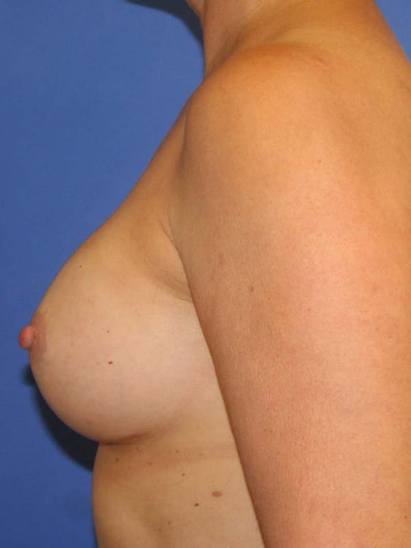 Breast Augmentation Before & After Gallery - Patient 9605732 - Image 4