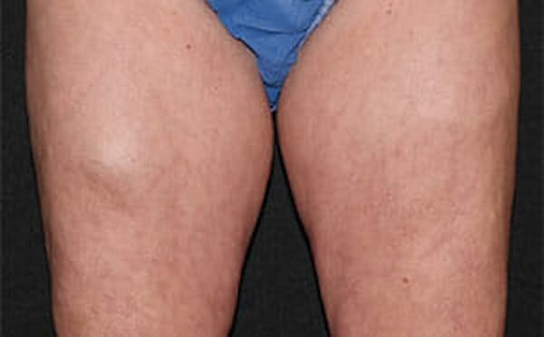 CoolSculpting® Elite Before & After Gallery - Patient 9605733 - Image 1