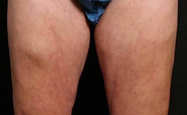 CoolSculpting® Elite Before & After Gallery - Patient 9605733 - Image 2