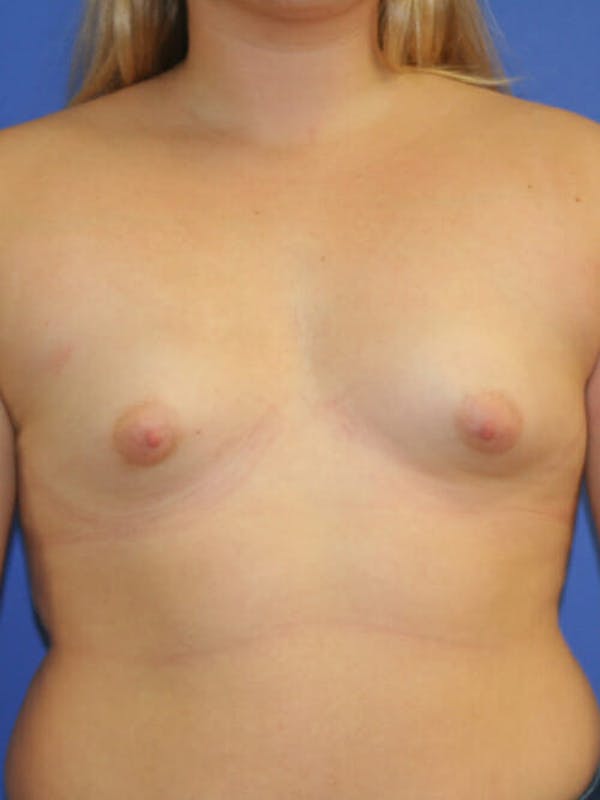 Breast Augmentation Before & After Gallery - Patient 9605744 - Image 1