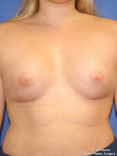 Breast Augmentation Before & After Gallery - Patient 9605744 - Image 2