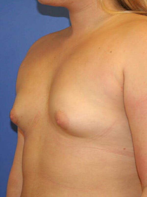 Breast Augmentation Before & After Gallery - Patient 9605744 - Image 3