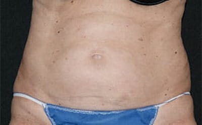 CoolSculpting® Elite Before & After Gallery - Patient 9605741 - Image 1