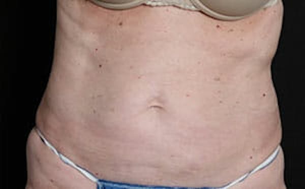 CoolSculpting® Elite Before & After Gallery - Patient 9605741 - Image 2