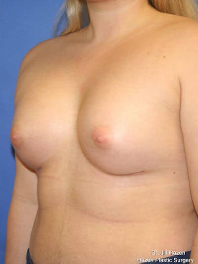 Breast Augmentation Before & After Gallery - Patient 9605744 - Image 4