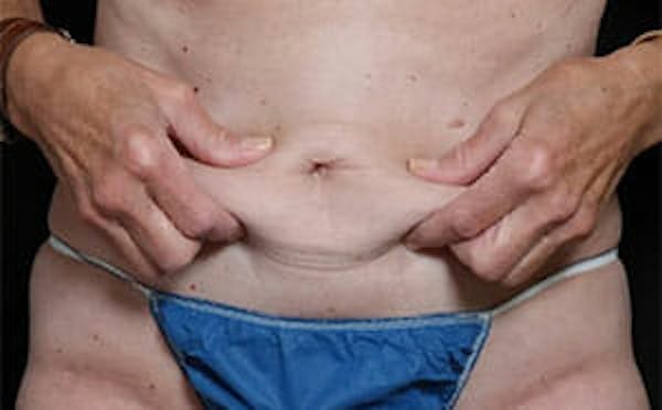CoolSculpting® Elite Before & After Gallery - Patient 9605741 - Image 3