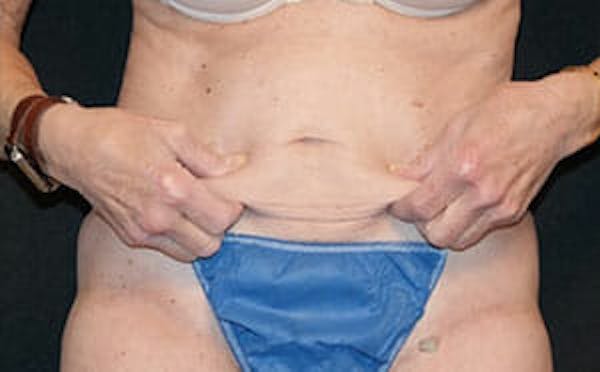 CoolSculpting® Elite Before & After Gallery - Patient 9605741 - Image 4