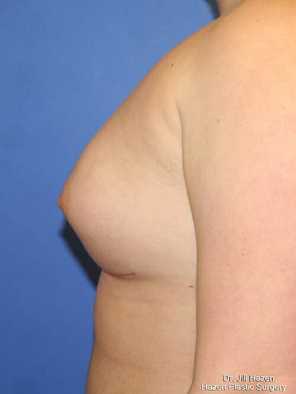 Breast Augmentation Before & After Gallery - Patient 9605744 - Image 6