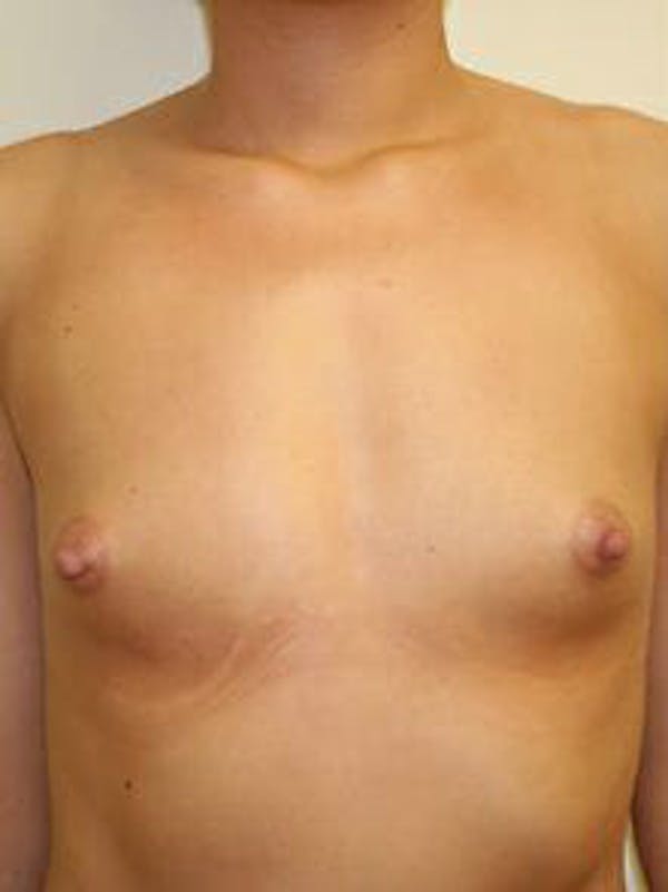 Breast Augmentation Before & After Gallery - Patient 9605747 - Image 1
