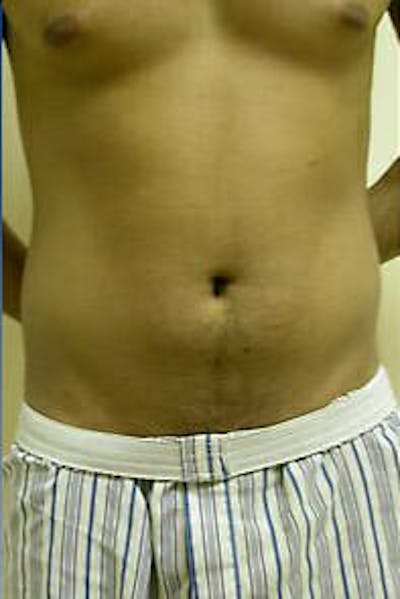 Male Liposuction Gallery - Patient 9605748 - Image 1