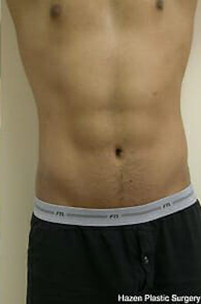 Male Liposuction Before & After Gallery - Patient 9605748 - Image 2