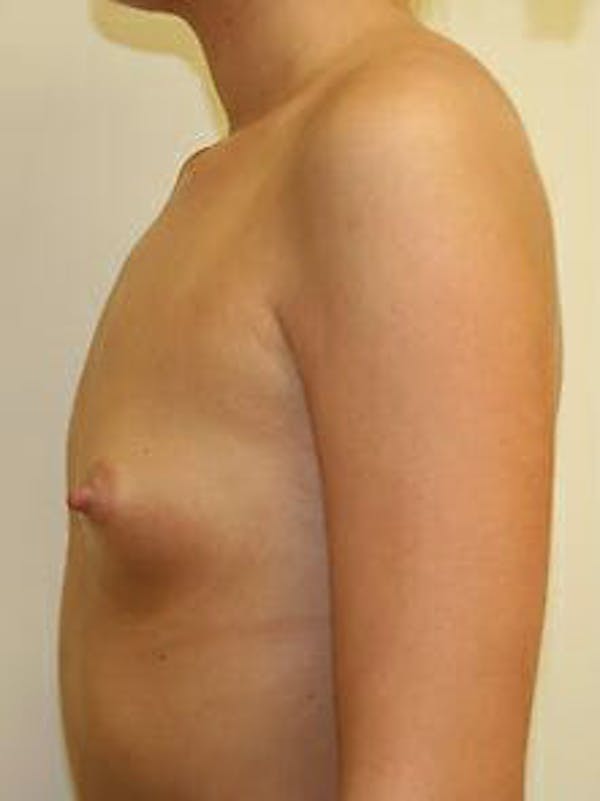 Breast Augmentation Before & After Gallery - Patient 9605747 - Image 5