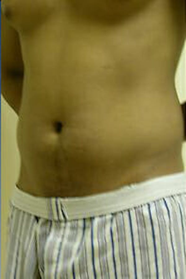 Male Liposuction Before & After Gallery - Patient 9605748 - Image 3