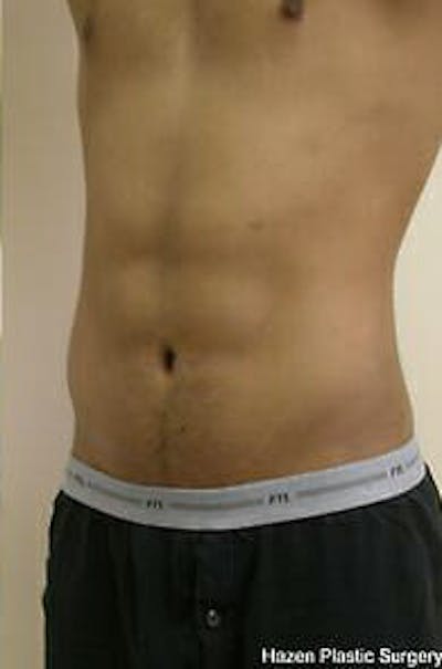 Male Liposuction Before & After Gallery - Patient 9605748 - Image 4