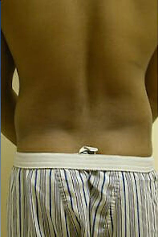 Male Liposuction Before & After Gallery - Patient 9605748 - Image 5