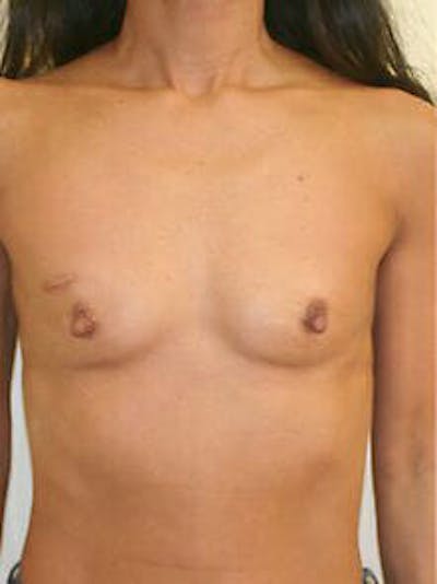 Breast Augmentation Before & After Gallery - Patient 9605750 - Image 1