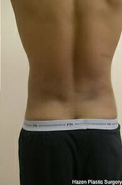 Male Liposuction Before & After Gallery - Patient 9605748 - Image 6
