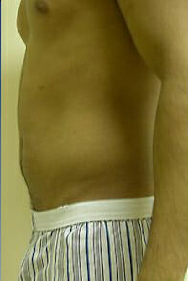 Male Liposuction Before & After Gallery - Patient 9605748 - Image 7