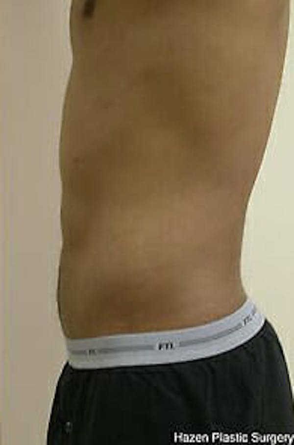 Male Liposuction Before & After Gallery - Patient 9605748 - Image 8
