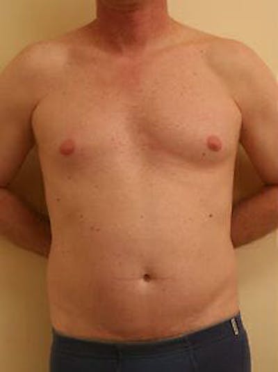 Male Liposuction Before & After Gallery - Patient 9605757 - Image 1