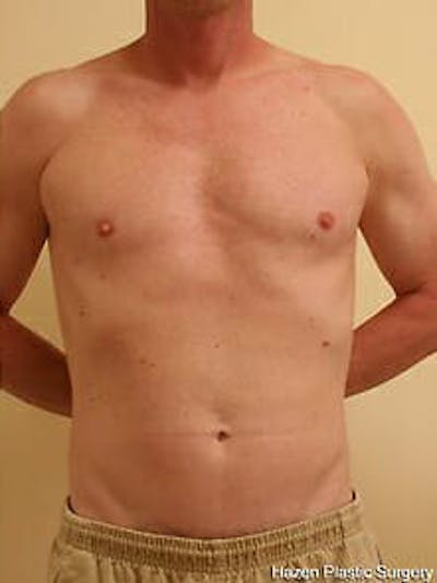 Male Liposuction Before & After Gallery - Patient 9605757 - Image 2